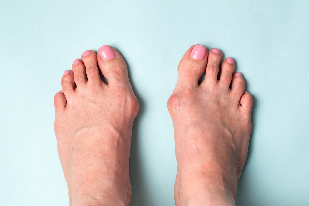 Hallux2 bioliek